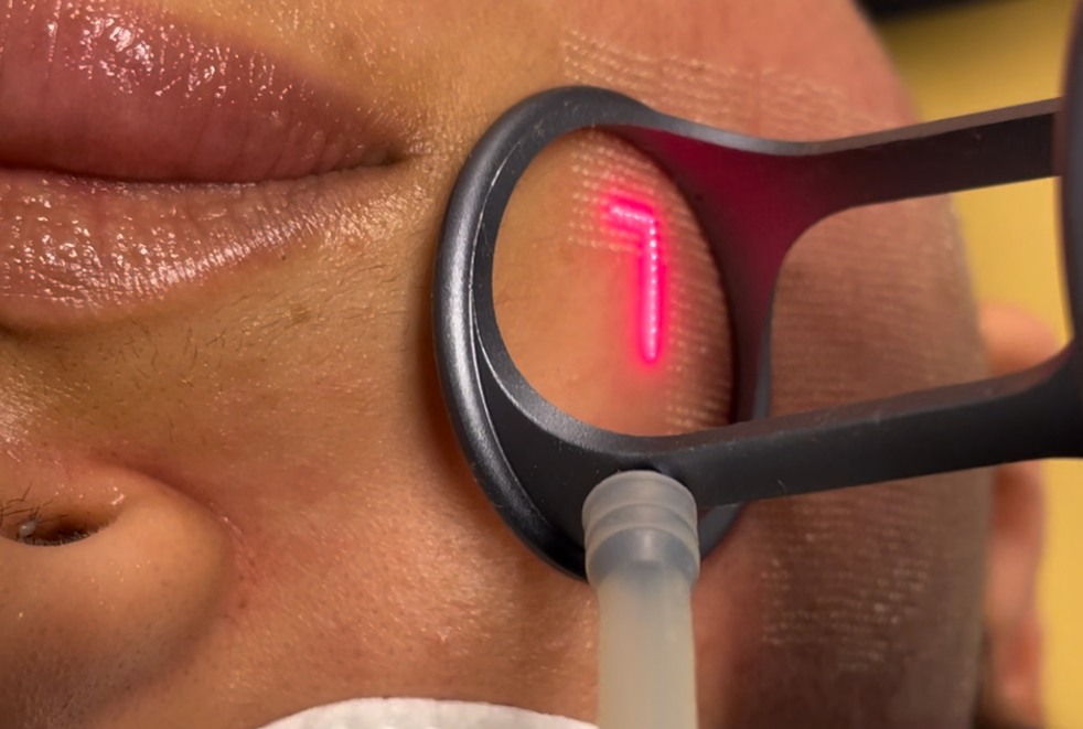 Laser Technology