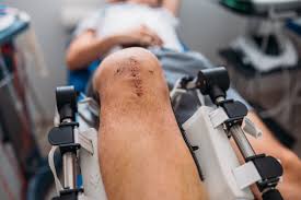 Joint Replacement