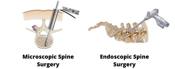 Spine Surgery