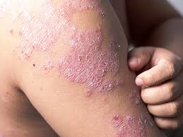 Eczema