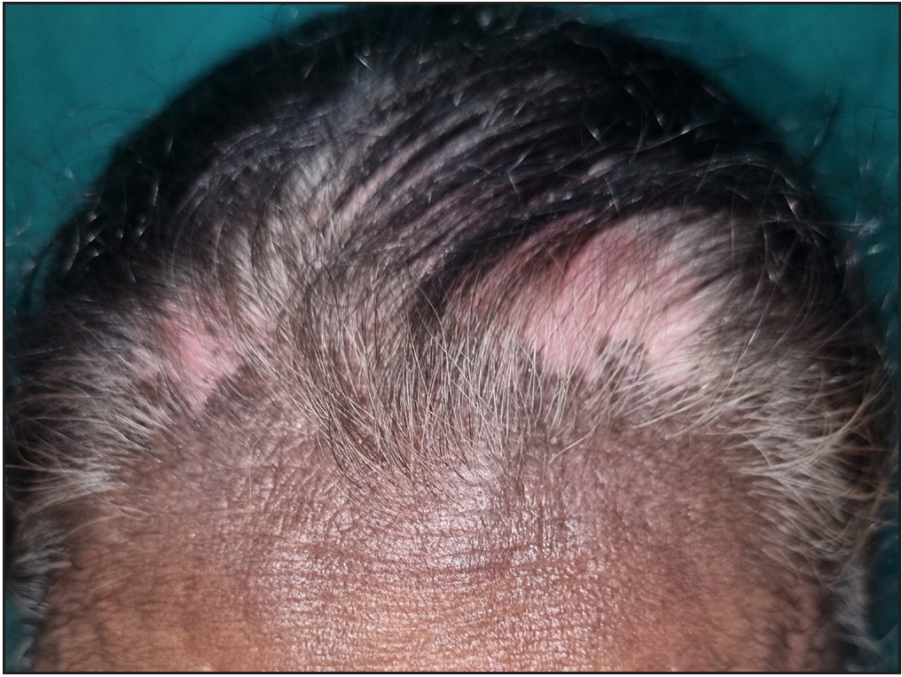 Hair Dye Dermatitis